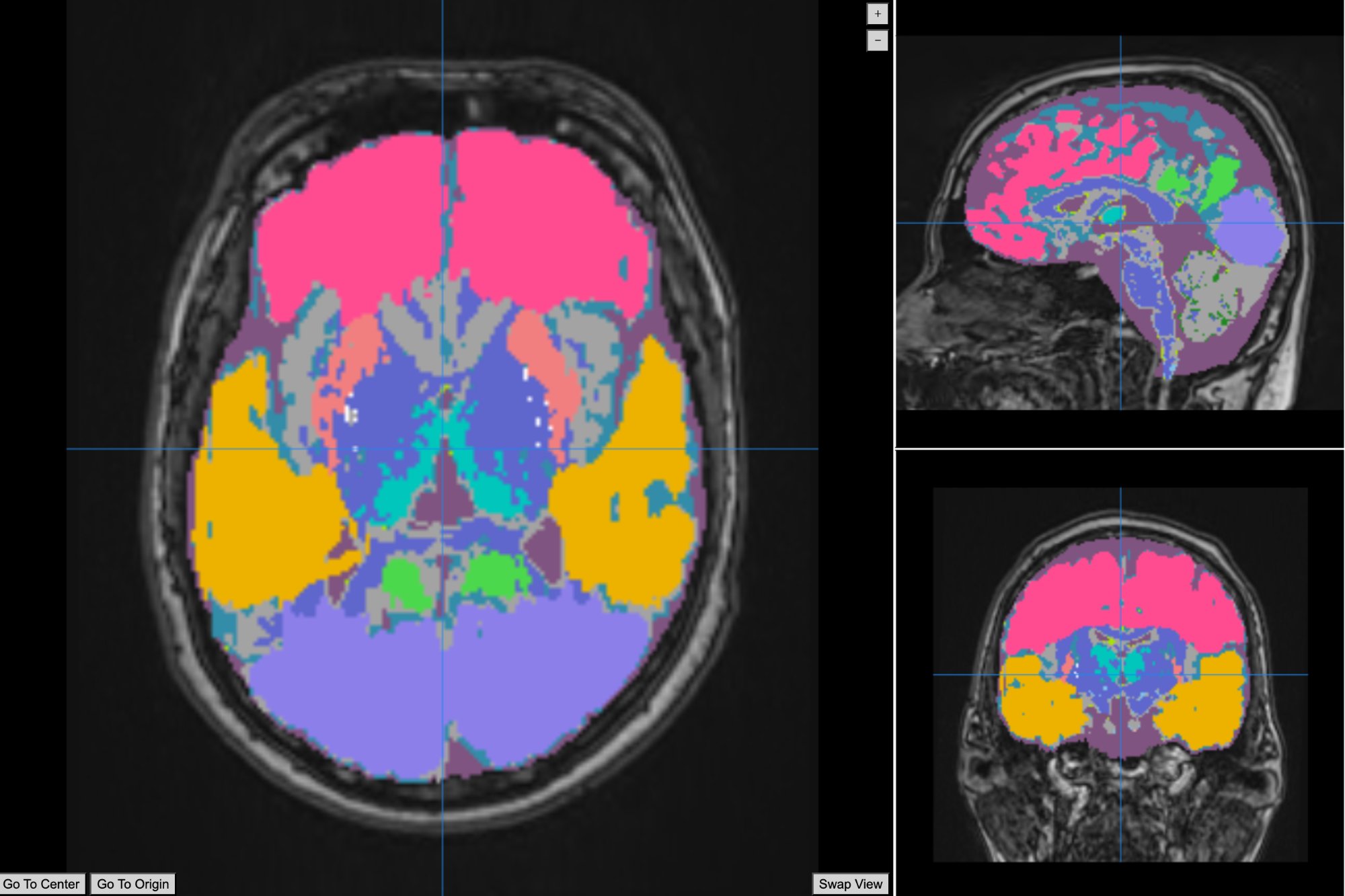 NeuroShield Brain Segmentation — Axial, Sagittal, Coronal Views